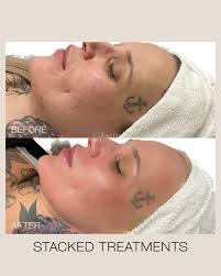 RF Micro Needling Facial Pleasanton