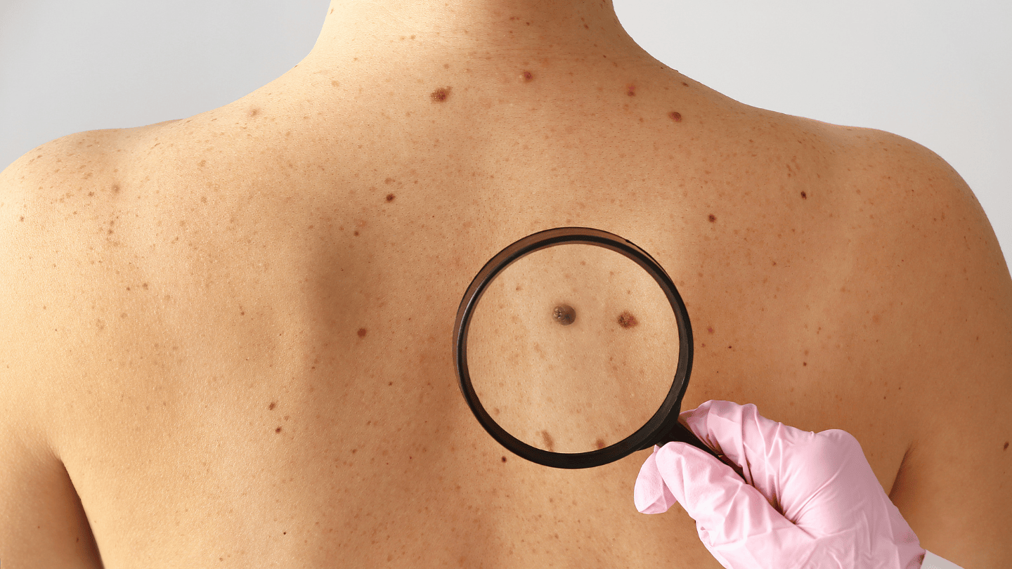 Dermatologist Orlando | Allergy & Asthma Center | Skin check, Acne, Skin Cancer, Moles